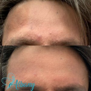 microneedling results