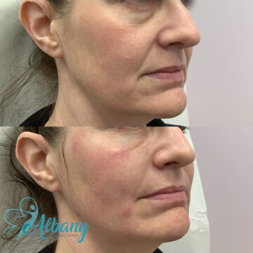 before and after platelet-rich fibrin