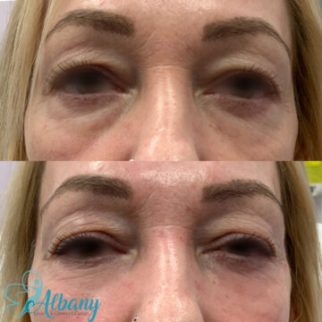 under eye fillers results