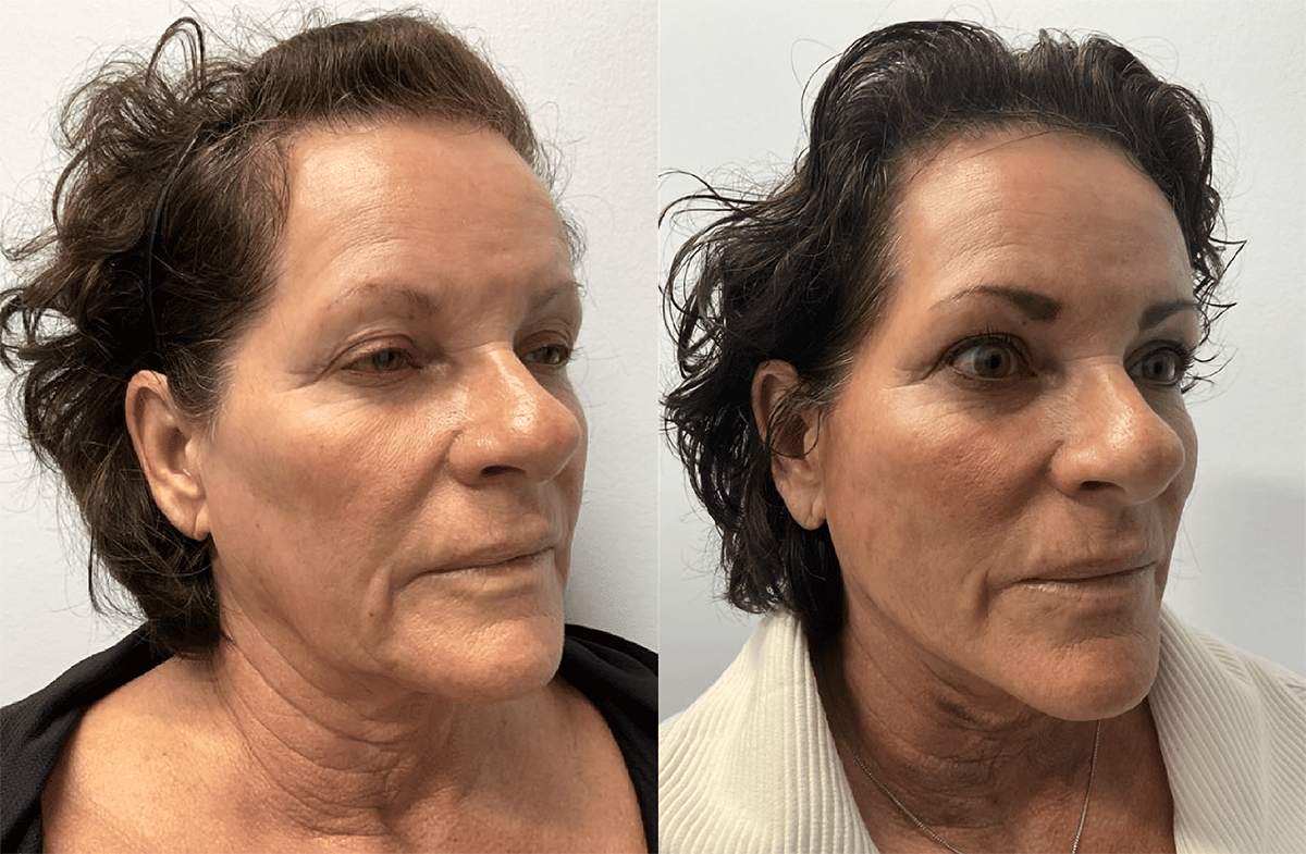 a picture showing showing a female in her 50s before and after receiving Sculptra in Edmonton