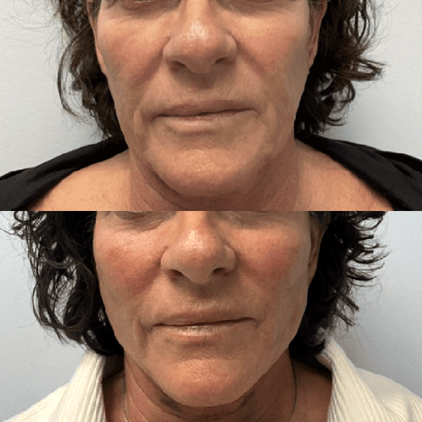 Sculptra effect after 6 month