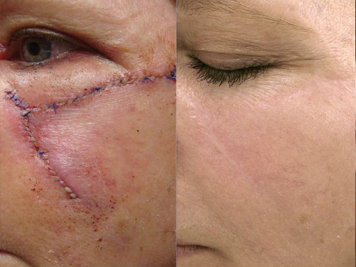 Before and after surgical scar treatment on a female patient. Significant reduction in scar visibility and smoother skin texture.