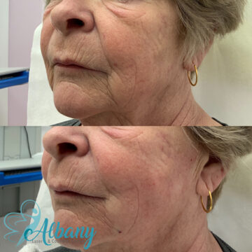 thread lift results