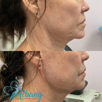 Thread lift jawline contouring