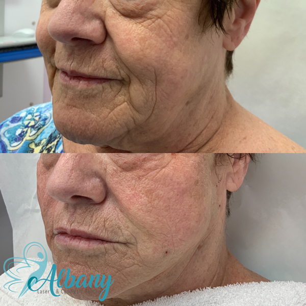 non-surgical facelift edmonton