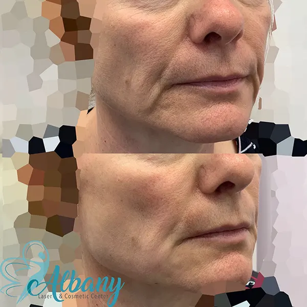 non surgical facelift