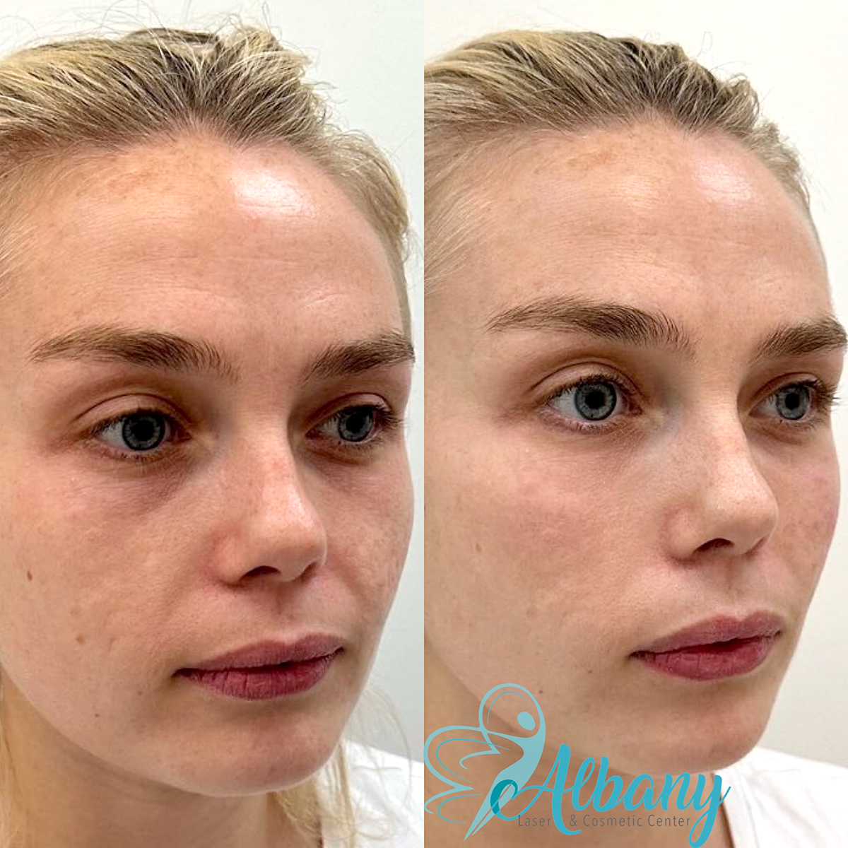 Undereye fillers Resutls