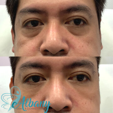 under eye fillers edmonton