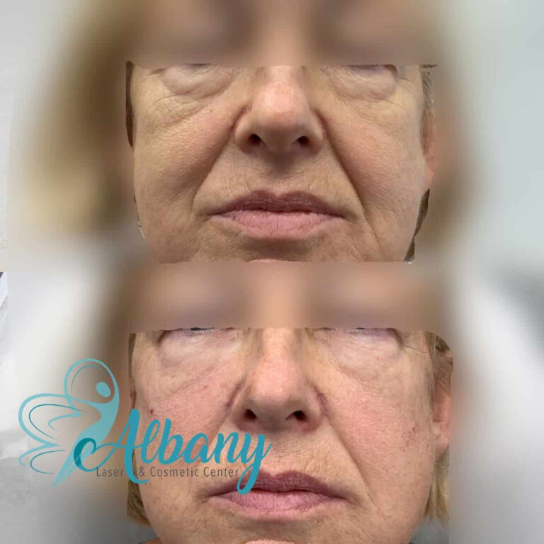 before and after undereye fillers