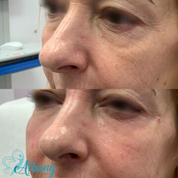 under eye filler results