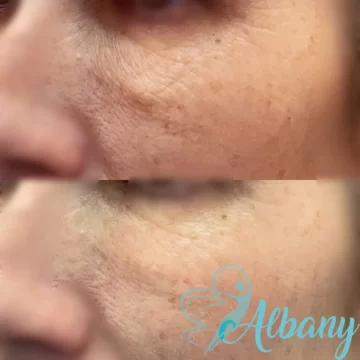under eye wrinkle with laser