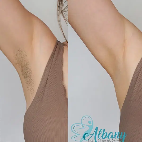 Before and after images of underarm hair removal, highlighting smooth, hair-free skin and reduced hair growth.