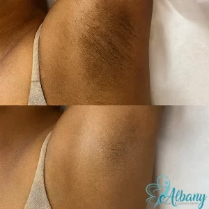 Before and after image showing significant underarm whitening results following 6 sessions of cosmetic skin treatment at Albany Cosmetic and Laser Centre